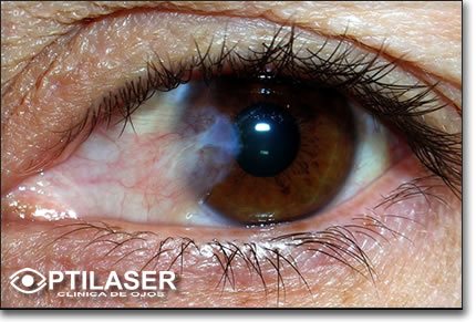 Clinica de ojos Optilaser - Catarata